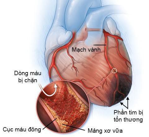 KHÔNG PHẢI UNG THƯ, MÀ ĐỘT QUỴ MỚI LÀ CĂN BỆNH KHỦNG KHIẾP NHẤT!!